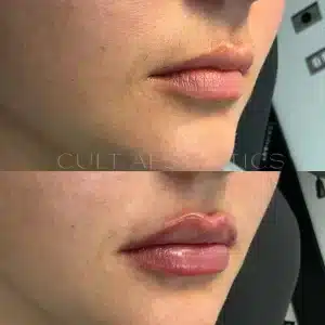 ژل لب در میاندوآب با دکتر رضا نصیرپور